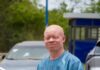 INTERNATIONAL ALBINISM AWARENESS DAY: GAPA Demands Urgent Action Against Discrimination, Calls for Dedicated Skin Cancer Fund